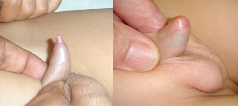 Sưng bao quy đầu xảy ra phổ biến ở trẻ nhỏ và làm phát sinh nhiều biến chứng nguy hiểm