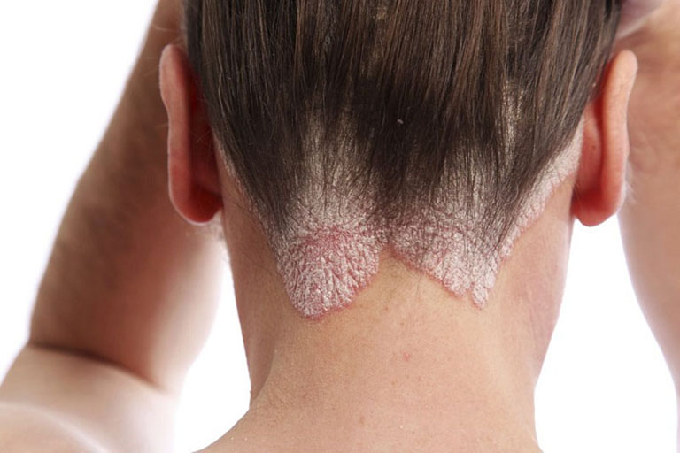 Á sừng da đầu gây ảnh hưởng nghiêm trọng đến thẩm mỹ bên ngoài của làn da