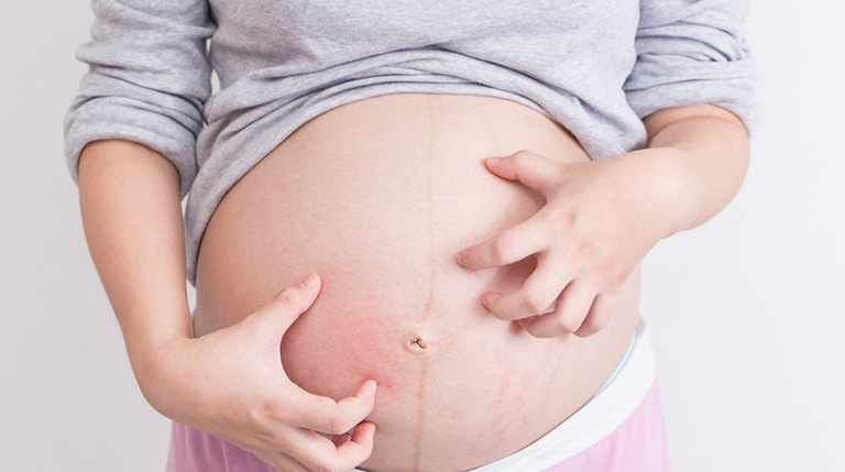 Viêm da dị ứng có thể di truyền từ bố mẹ sang bé qua quá trình mang thai