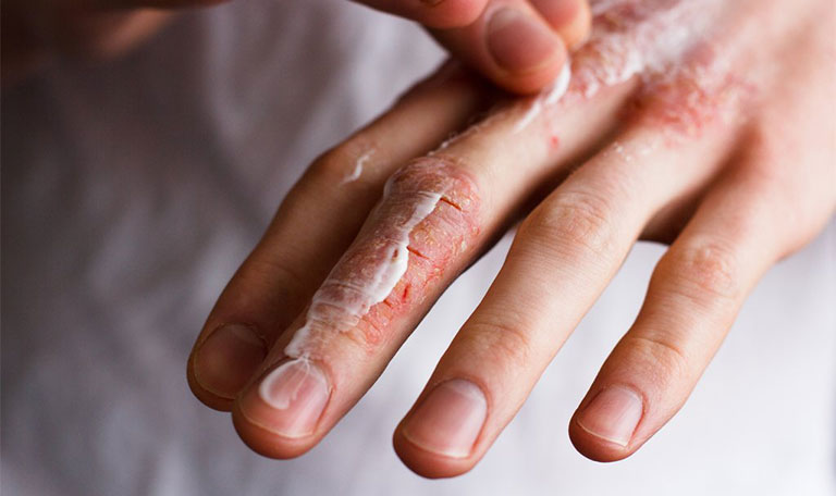 Chàm khô gây tổn thương ở đầu ngón tay gây ra nhiều bất tiện trong đời sống sinh hoạt hàng ngày