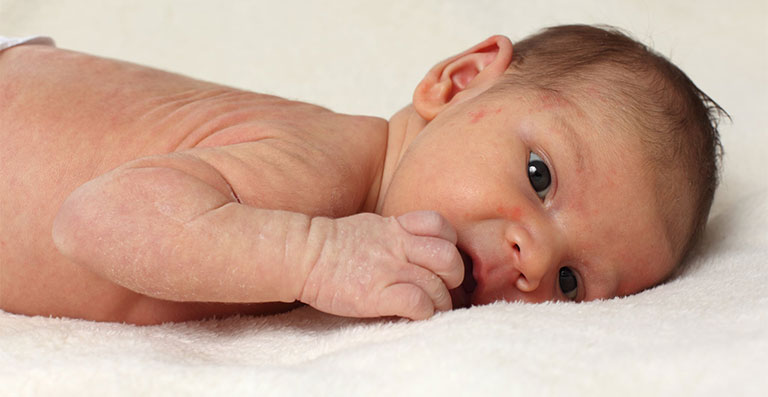Chàm ở trẻ sơ sinh và cách chữa