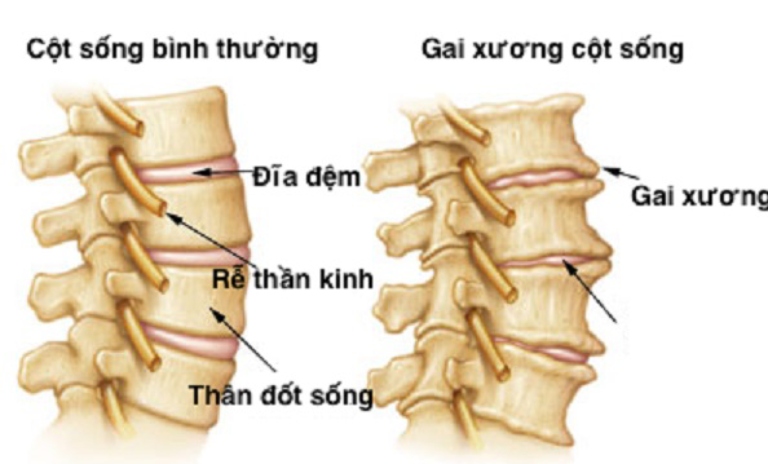 Sự lắng đọng canxi bất thương tại khớp và dây chằng hình thành nên các gai xương cột sống