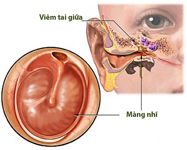 Viêm tai giữa là bệnh thường gặp ở nhiều đối tượng, tập trung chủ yếu ở trẻ nhỏ