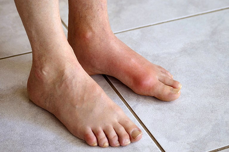 Chân sưng đau là triệu chứng điển hình của bệnh gout khiến người bệnh thấy rất khó chịu
