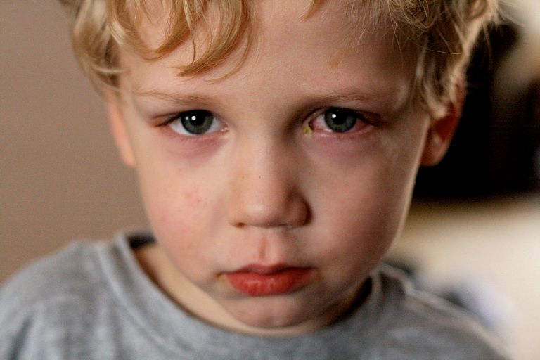 Trẻ bị viêm xoang có thể gặp các vấn đề về mắt