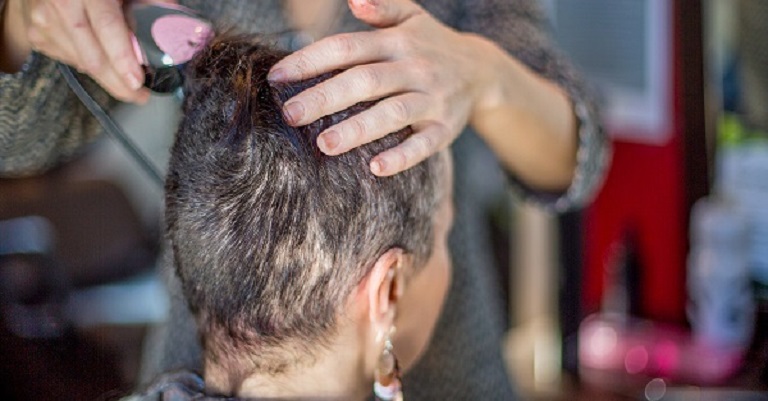 Rụng tóc sau hóa trị khiến người bệnh khá tự ti