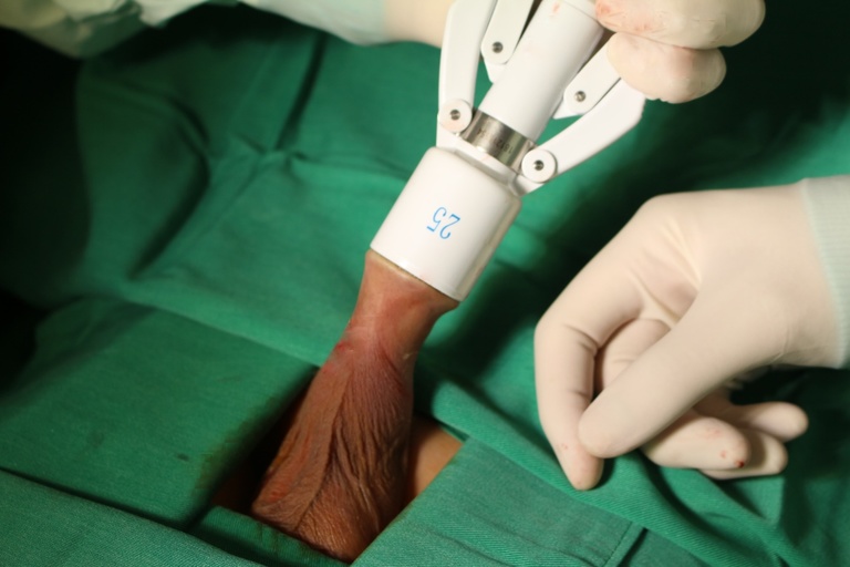 Cắt bao quy đầu bằng laser là phương pháp tiểu phẫu phổ biến