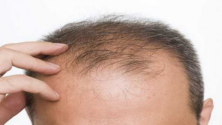 Những người bị hói hoặc rụng tóc vĩnh viễn nên thực hiện cấy tóc