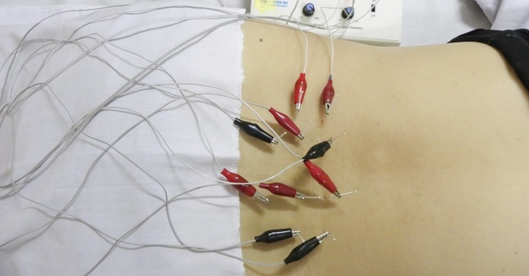 Phương pháp điện châm kết hợp giữa chữa bệnh bằng châm cứu và dòng điện