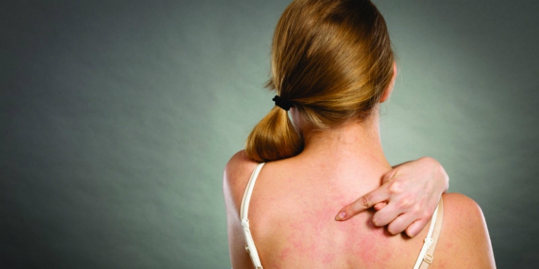 Không dùng tay cào gãi lên vùng da bị tổn thương để tránh nguy cơ nhiễm trùng