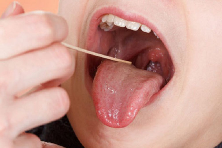 Cổ họng đau rát khi nuốt cũng có thể là triệu chứng của bệnh viêm amidan