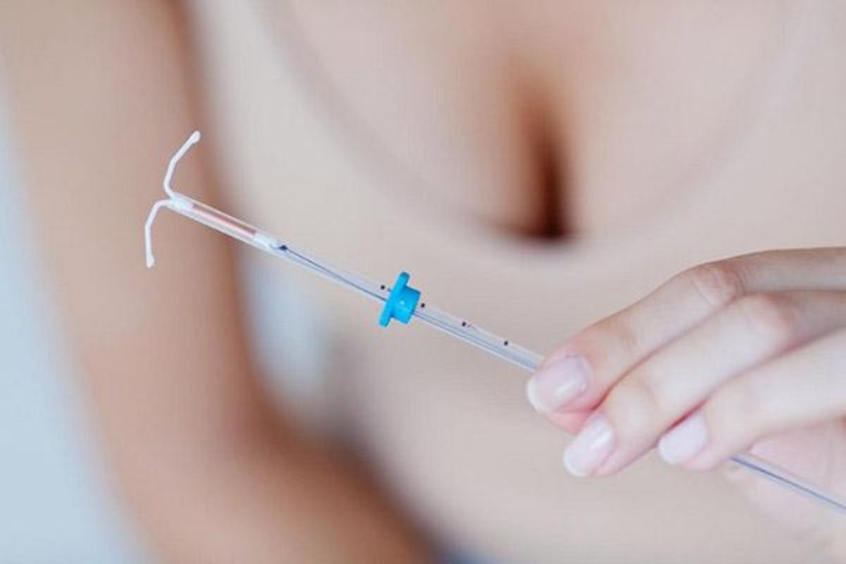Đặt vòng tránh thai trong tử cung giúp ngăn chặn quá trình làm tổ của trứng và tình trùng