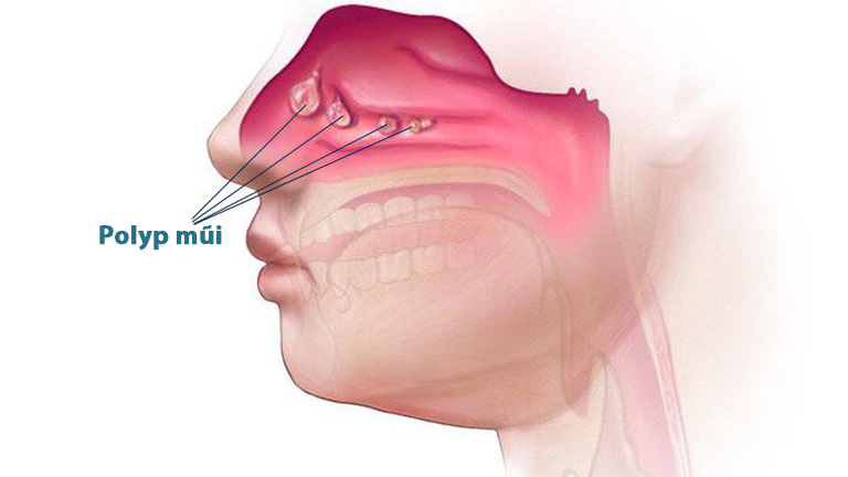 Dị ứng, nhiễm trùng hoặc hen phế quản có thể gây kích ứng polyp mũi