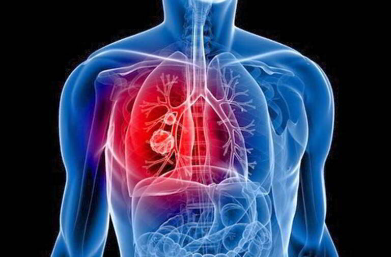 U phổi/ ung thư phổi rất nguy hiểm cho người bệnh và gây đau đớn