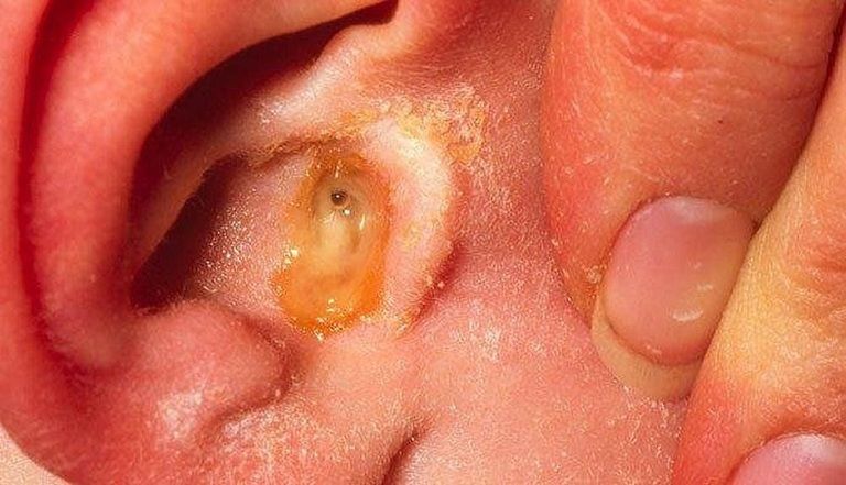Cơn đau tai ở trẻ có thể do bệnh viêm tai giữa gây ra