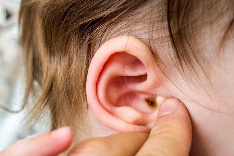 Ho viêm phế quản kéo dài khiến trẻ gặp biến chứng viêm tai giữa