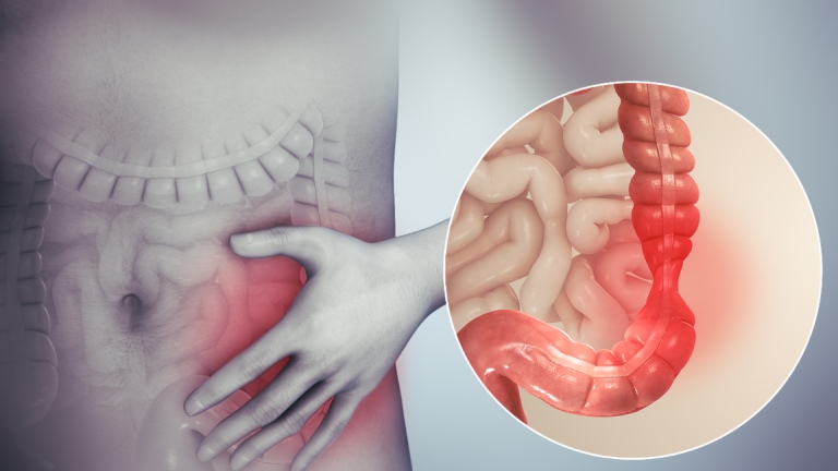 Đau bụng tiêu chảy là triệu chứng điển hình của hội chứng ruột kích thích