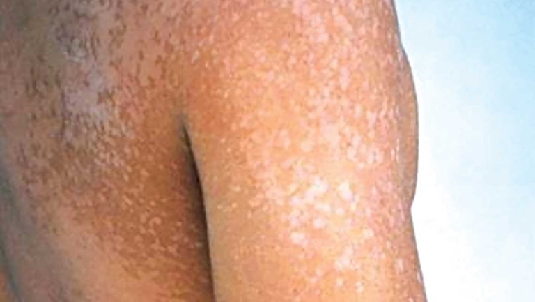 Bệnh lang ben hình thành trên da trẻ các đốm da không đều màu với vùng da xung quanh