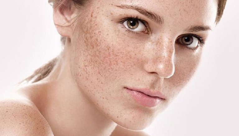 Nám da thường xuất hiện ở vùng da mặt, đối xứng hai bên gò má