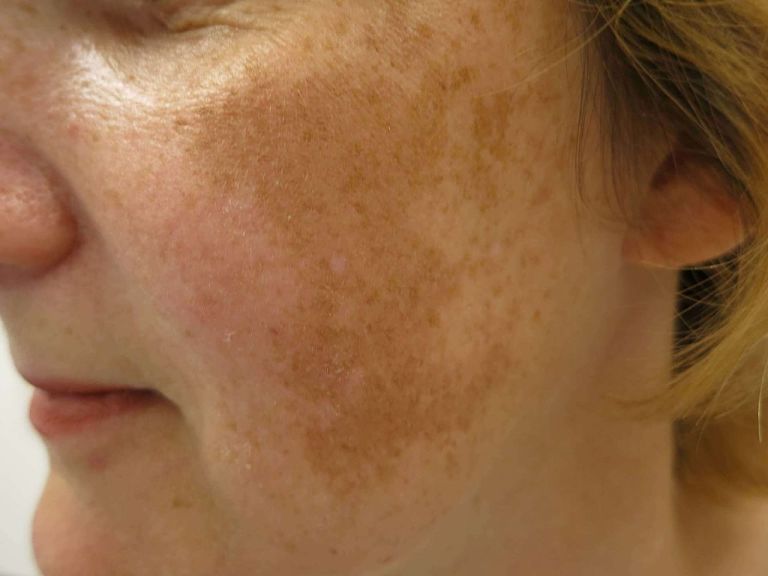 Nám mảng là một trong những rối loạn sắc tố da thường gặp