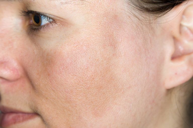 Da bị nám nhẹ là các đốt nám hơi sẫm và chưa quá tách biệt với vùng da xung quanh