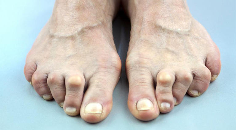Đau ngón chân cái là dấu hiệu bệnh gout