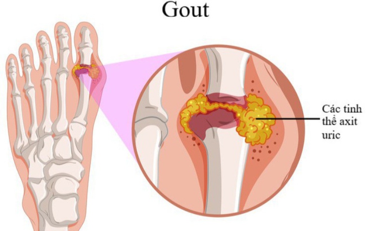 Bệnh gout hình thành do các sự lắng đọng acid uric ngay tại khớp gây sưng viêm và đau nhức