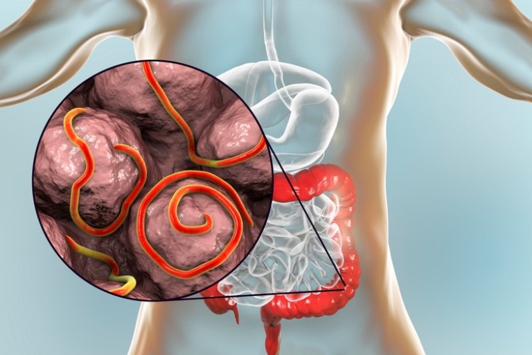 Đau bụng từng cơn cũng có thể xảy ra khi cơ thể bạn bị nhiễm giun hoặc ký sinh trùng