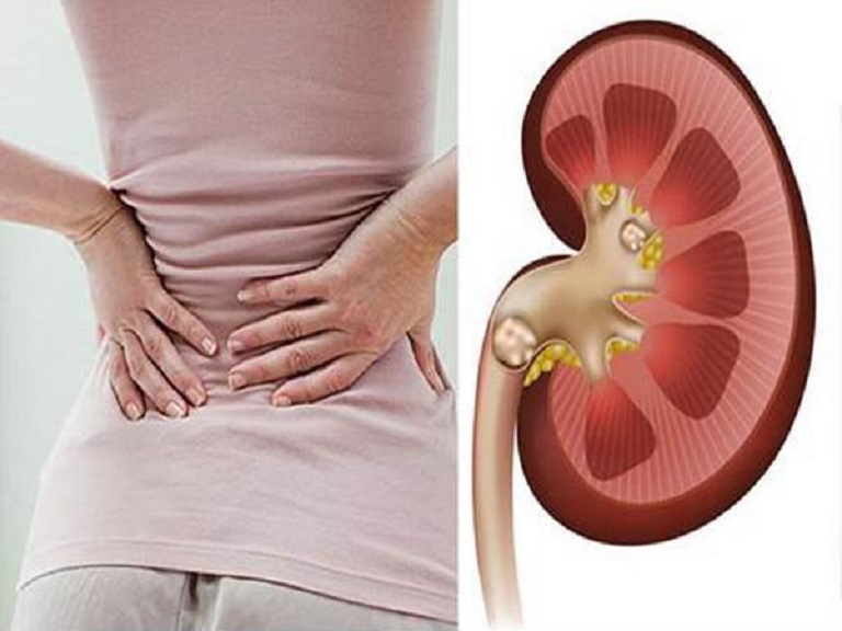 Đau lưng là một triệu chứng thường gặp của bệnh nhiễm khuẩn tiết niệu