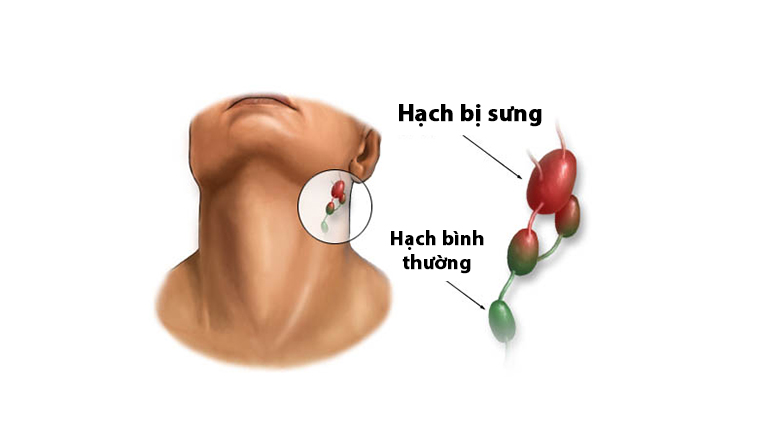 Nổi hạch sau tai có thể cảnh báo một số tình trạng sức khỏe từ nhẹ tới nghiêm trọng