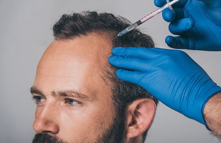 Quy trình cấy tóc phải trải qua nhiều giai đoạn thực hiện và đòi hỏi bác sĩ có tay nghề cao