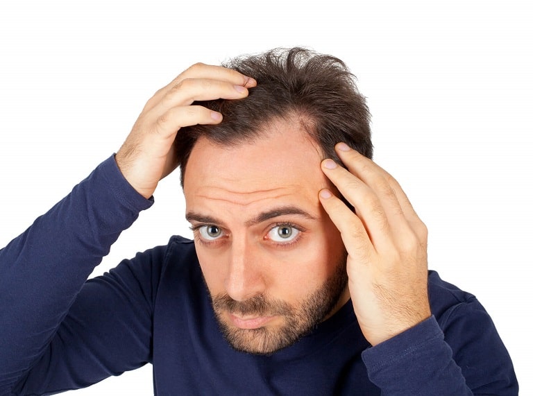 Rụng tóc thái dương có thể dẫn tới hói đầu