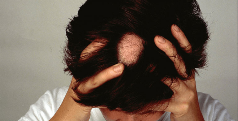 Rụng tóc từng mảng còn được gọi là rụng tóc từng vùng