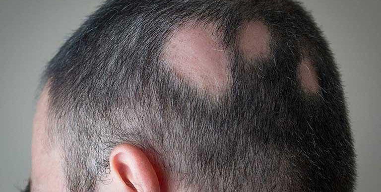 Rụng tóc diễn ra đột ngột, phát triển chỉ trong vài ngày hoặc vài tuần