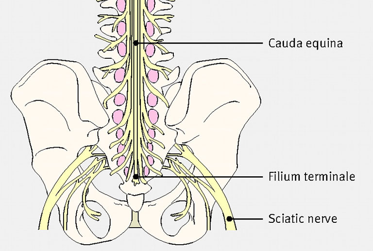 Triệu chứng thoát vị đĩa đệm cột sống thắt lưng