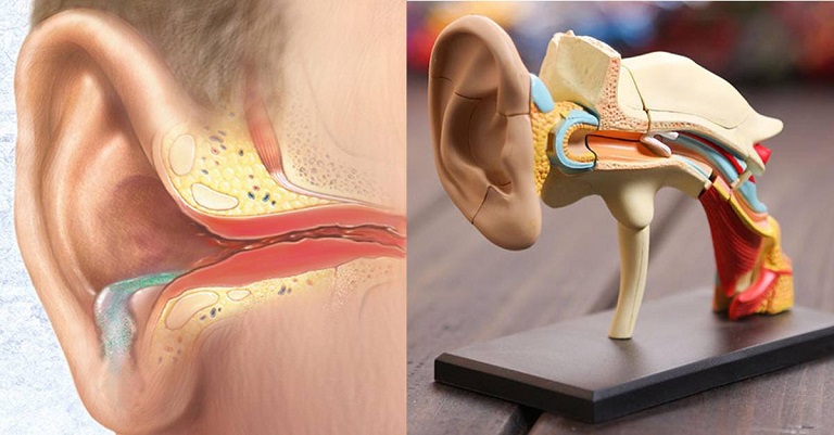 Thối tai là một bệnh lý xuất hiện chảy dịch tai kèm mùi hôi thối