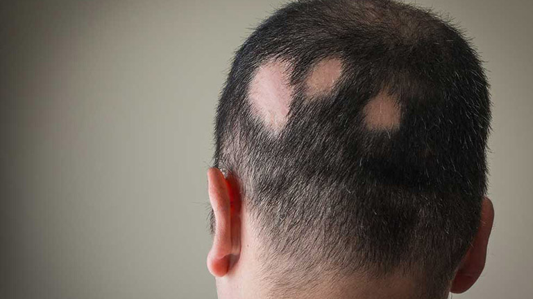 Hắc lào ở trên da đầu có thể để lại sẹo, gây rụng tóc vĩnh viễn ở vùng da bị ảnh hưởng