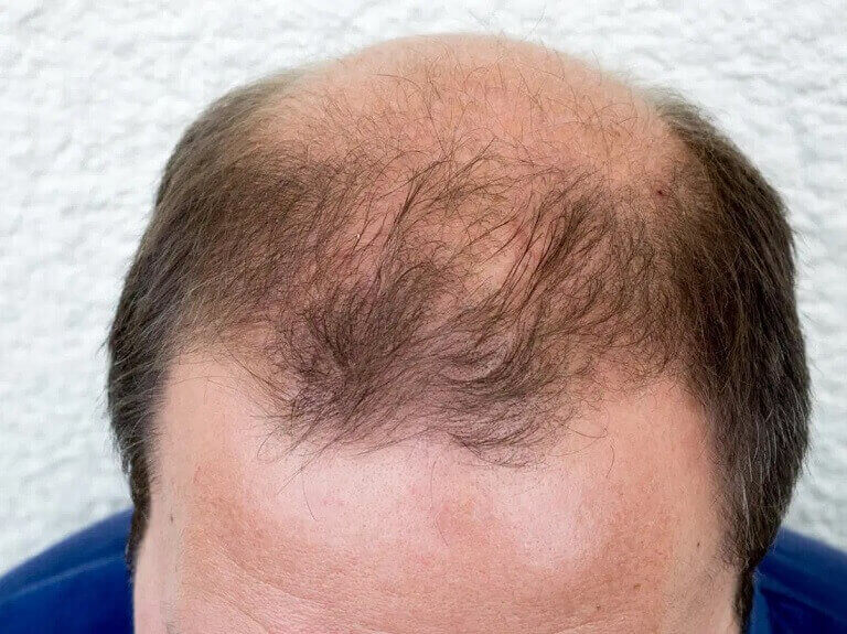 Tóc rụng nhiều ở nam giới gây ra các vùng hói theo chữ O, M, U