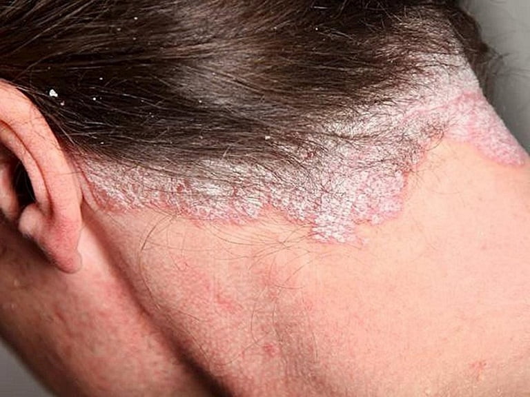 Nguyên nhân do các bệnh lý ở vùng da đầu khiến tóc rụng
