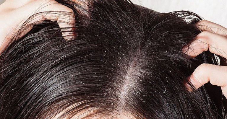 Có nên nhổ tóc sâu tóc ngứa không?