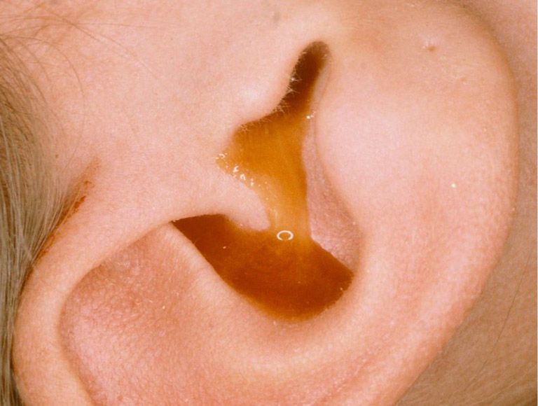 Dịch lãng mủ ở tai là dấu hiệu bất thường, cho thấy bạn đang gặp vấn đề nào đó về tai