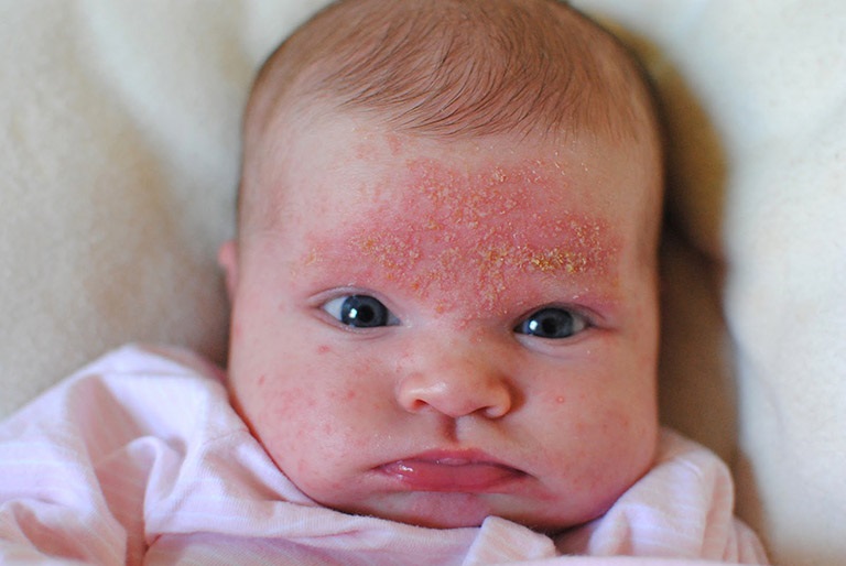 Bệnh xuất hiện với các mảng da hơi trắng, vàng hoặc hồng ở đầu trẻ