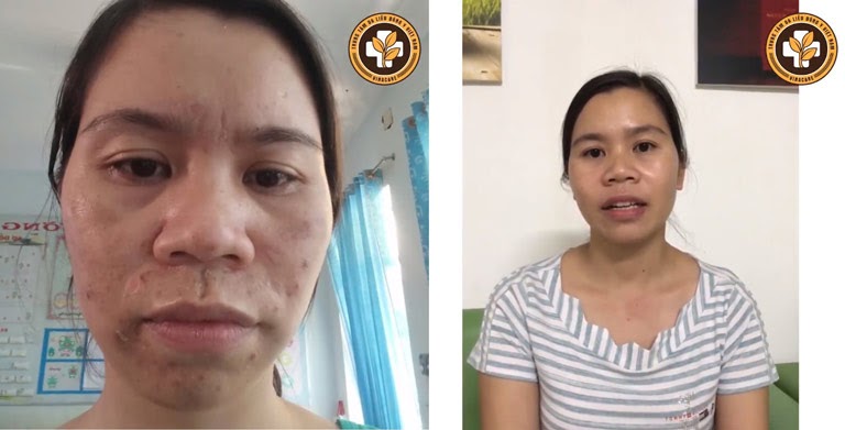 Kết quả sau khi sử dụng sản phẩm trị nám tàn nhang Vương Phi của chị Nụ ở Bình Phước