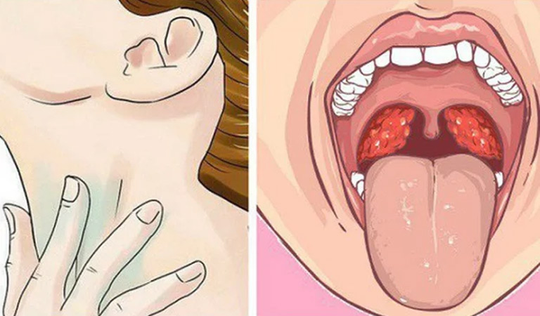 Dấu hiệu nhận biết bệnh viêm họng nổi hạch
