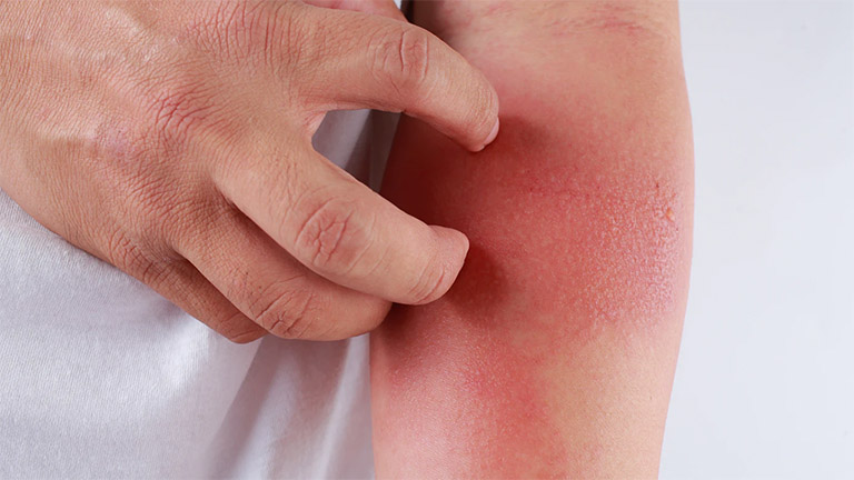 Ngứa ngáy khó chịu, da nổi dát đỏ là những triệu chứng phổ biến của bệnh viêm da cơ địa