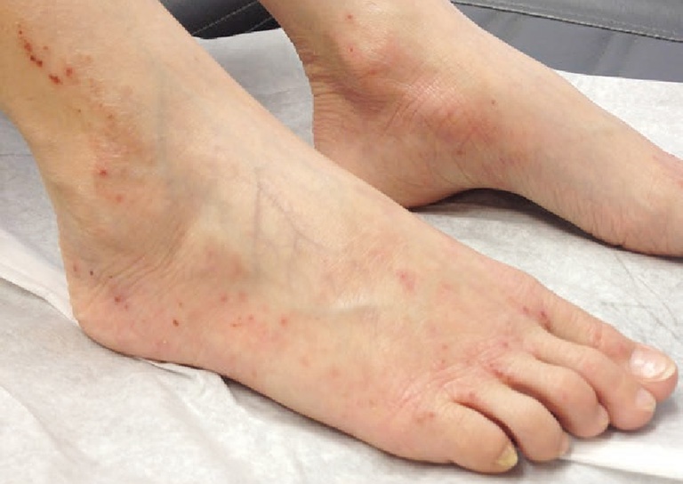 Viêm da cơ địa gây tổn thương ở chân là trường hợp xảy ra khá phổ biến
