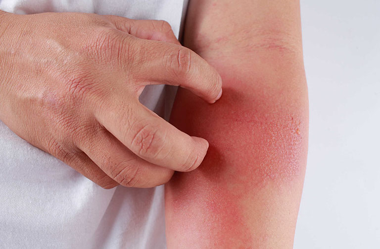 Viêm da tiếp xúc có thể khởi phát từ rất nhiều nguyên nhân, khiến người bệnh đau đớn, khó chịu