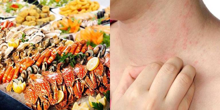 Người bị viêm da tiết bã nên tránh ăn các thực phẩm dễ gây dị ứng như hải sản