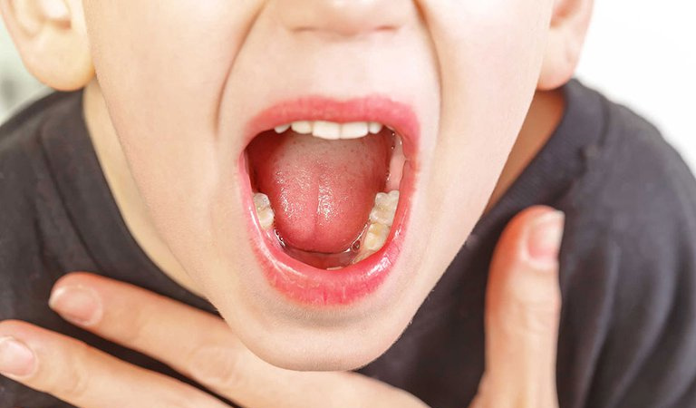 Viêm họng do virus là gì? 