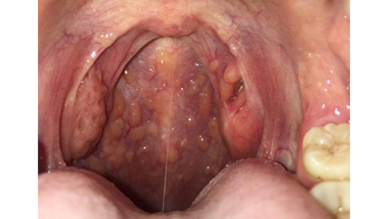 Viêm họng hạt và ung thư vòm họng là bệnh lý thường bị nhầm lẫn